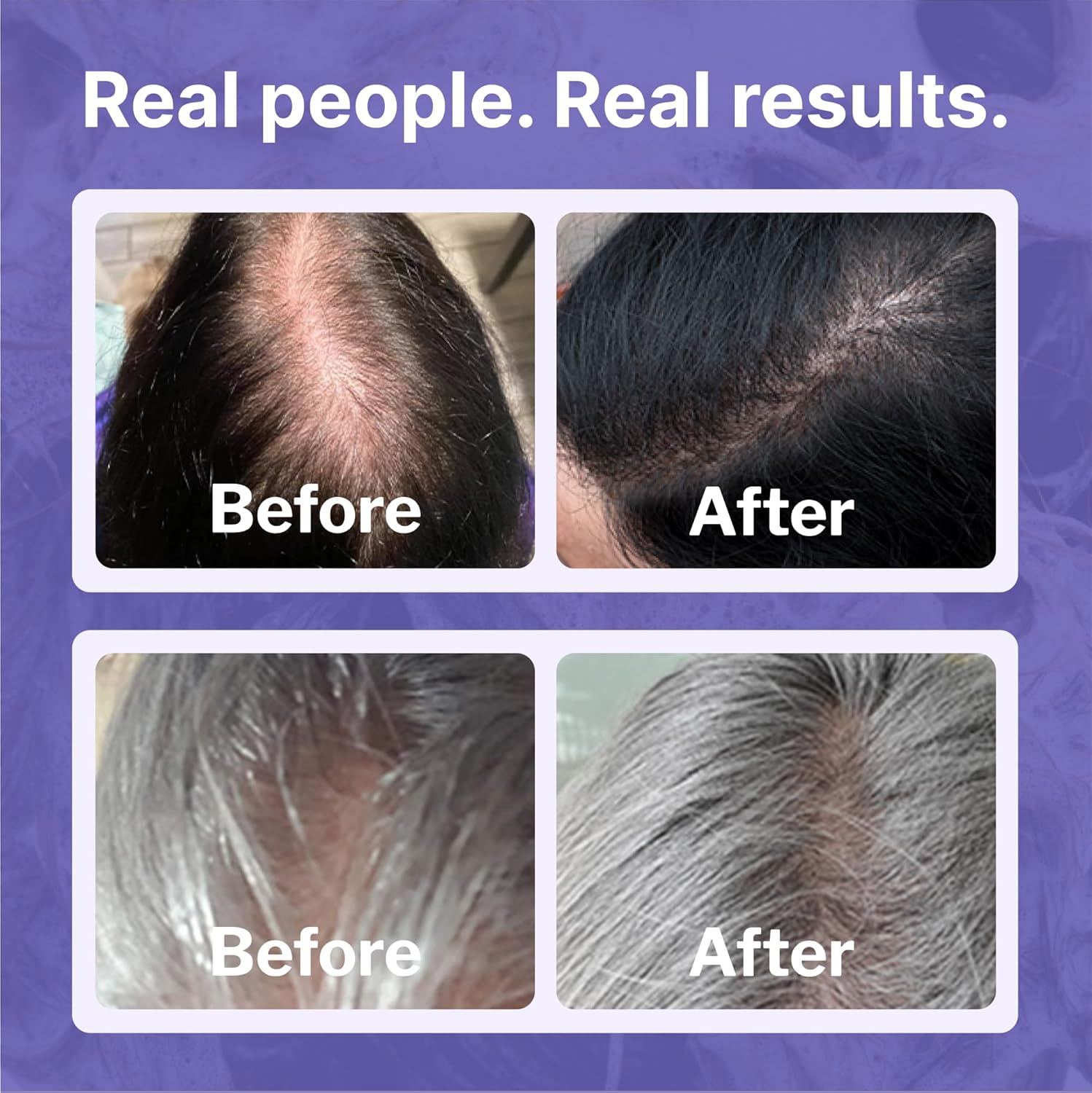 Women's Regrowth Kit: Shampoo, Conditioner, 2% Minoxidil, Leave-In Foamer U381747